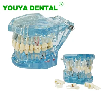 Стоматологическая модель, реставрация имплантатов, Мостовидный протез, стоматолог, медицинская наука, преподавание стоматологических заболеваний, Демонстрационная модель
